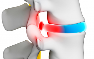 Bandscheibenvorfall dargestellt mit 3-D-Animation Wirbelsäule